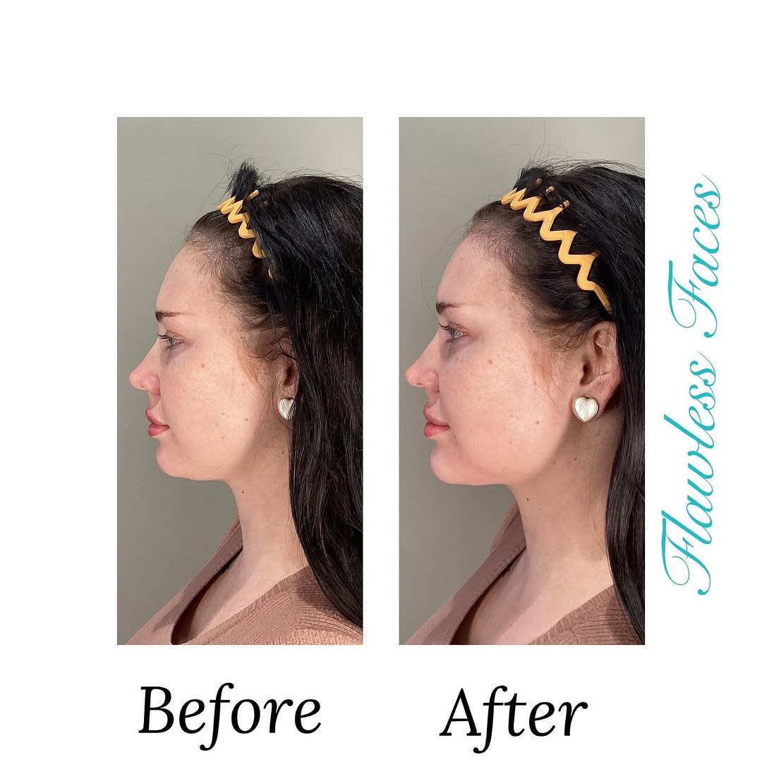 Before and after chin / jaw at Flawless Faces Med Spa Chandler AZ