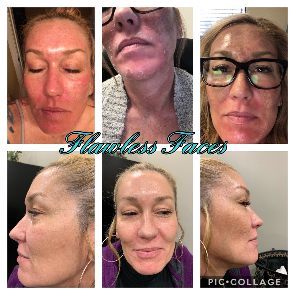 Before and after face at Flawless Faces Med Spa Chandler AZ