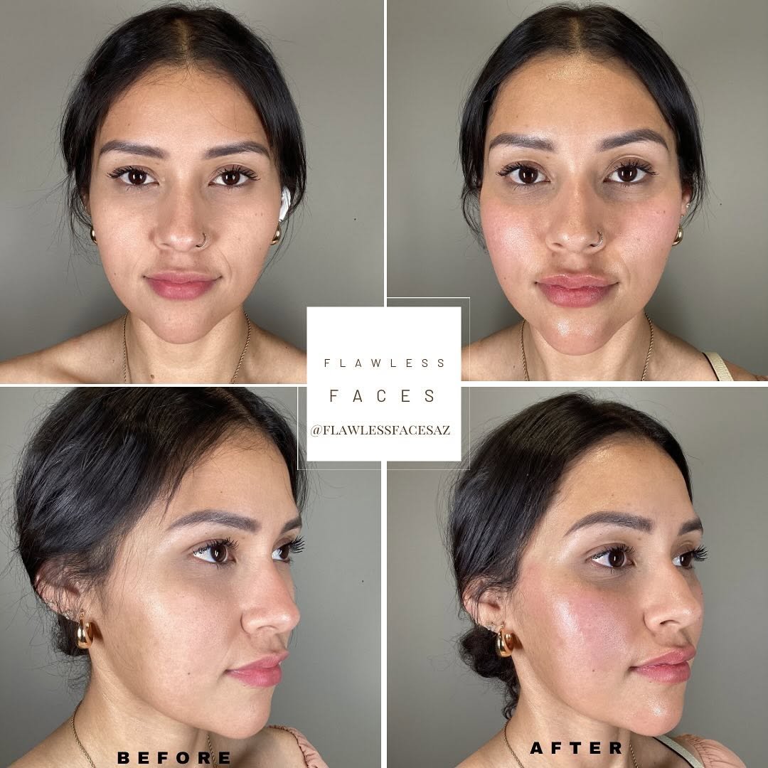 Juvéderm cheek filler before and after — front + 3/4 view, lift and volume