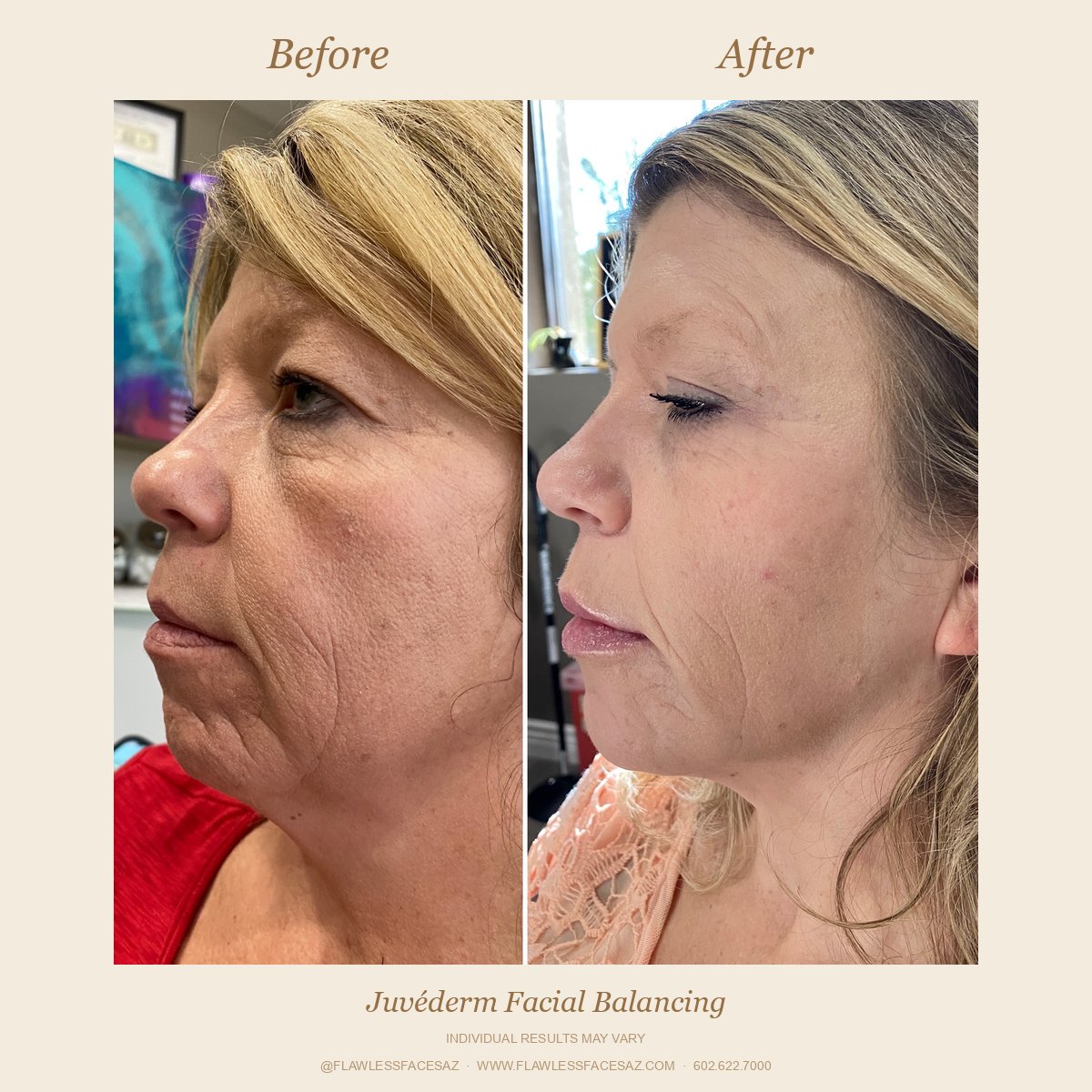 Before and after facial balancing at Flawless Faces Med Spa Chandler AZ