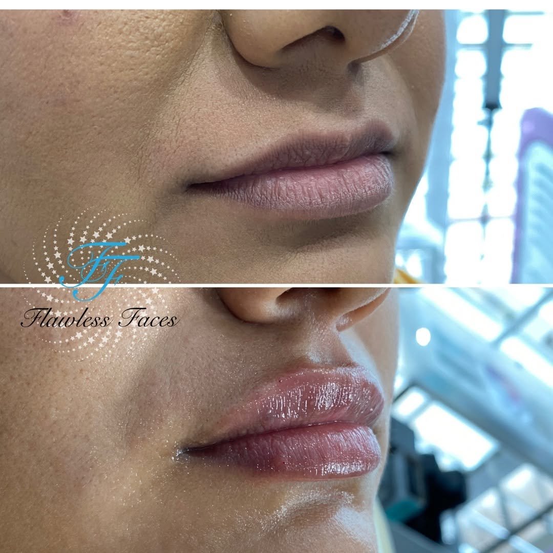 Juvéderm lip filler before and after — 3/4 view, natural-looking volume
