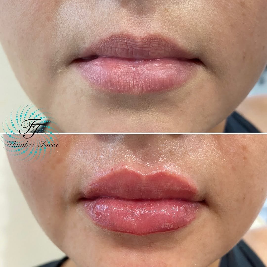 Juvéderm lip filler before and after — front view, soft volume