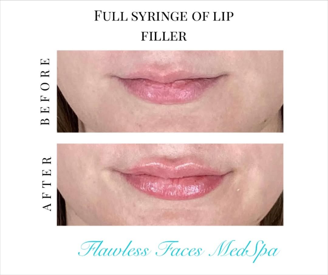Juvéderm full-syringe lip filler before and after at Flawless Faces Med Spa Chandler AZ