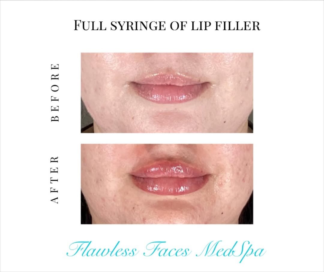 Juvéderm full-syringe lip filler before and after — fuller pout, natural shape