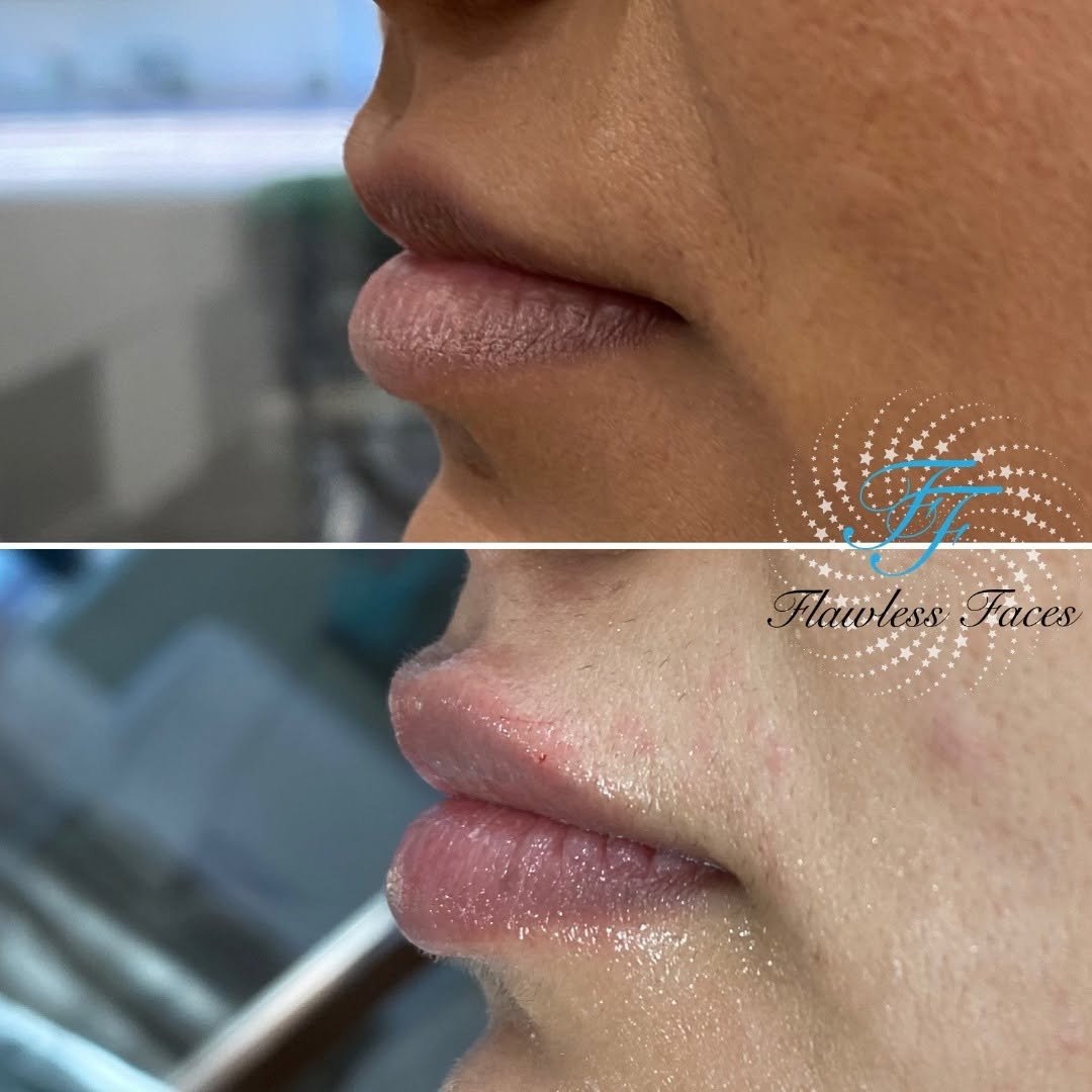 Juvéderm lip filler before and after — side profile, projection + shape