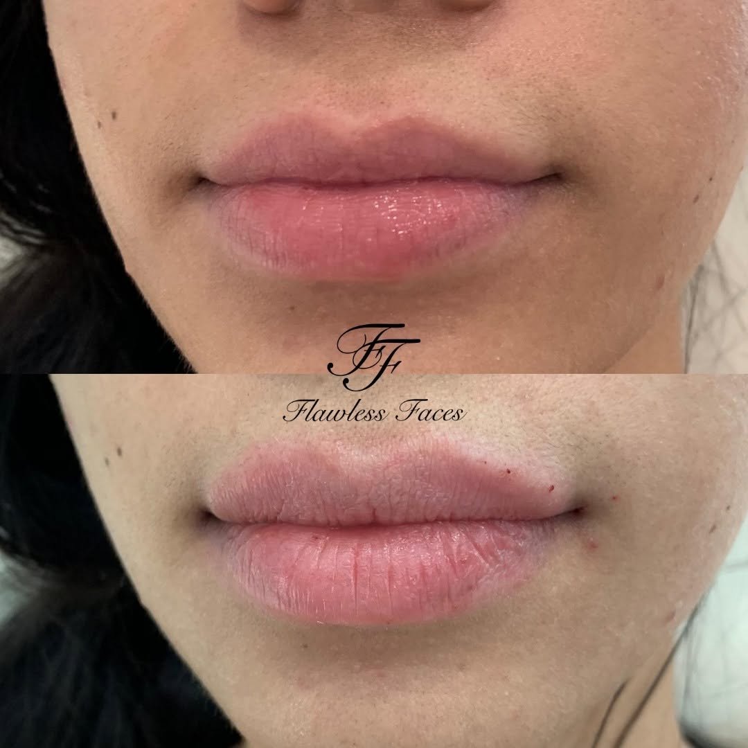 Juvéderm lip filler before and after — front view, soft enhancement