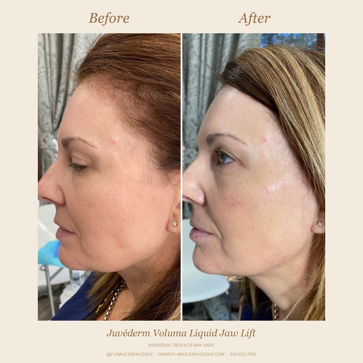 Juvéderm Voluma liquid jaw lift before and after at Flawless Faces Med Spa Chandler AZ