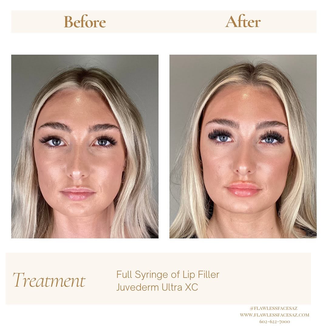 Before and after lip filler at Flawless Faces Med Spa Chandler AZ