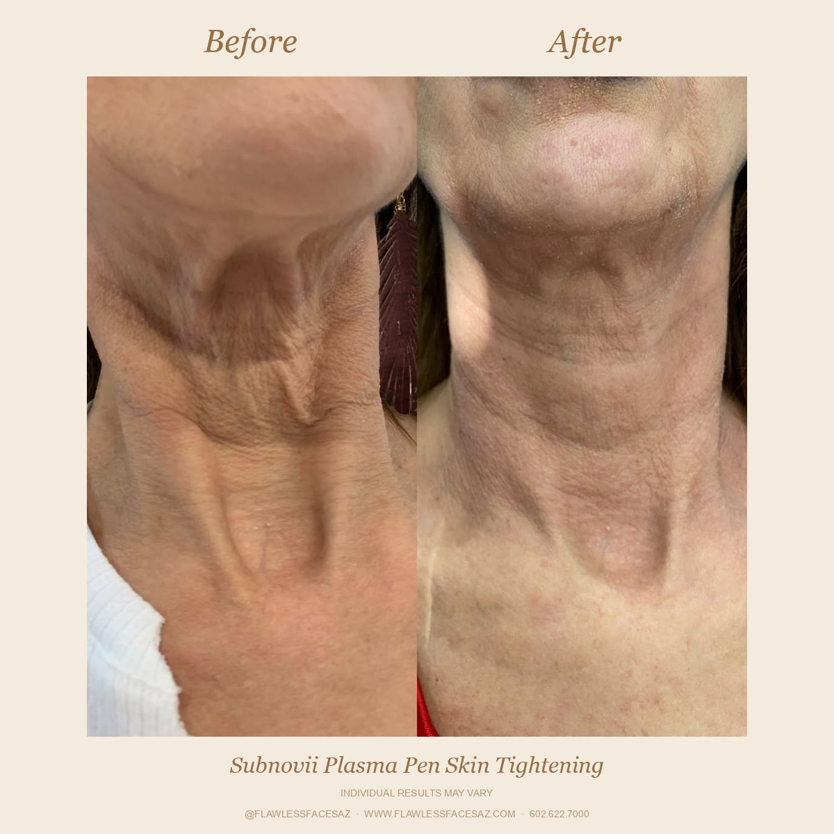 Subnovii Plasma Pen neck skin tightening before and after at Flawless Faces Med Spa Chandler AZ